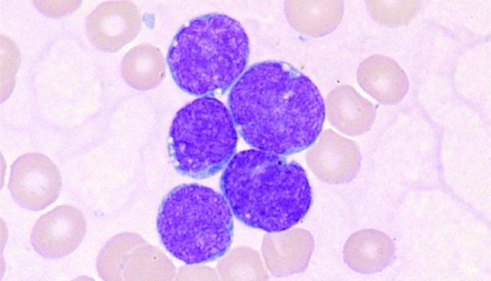 Acute Lymphoblastic Leukaemia