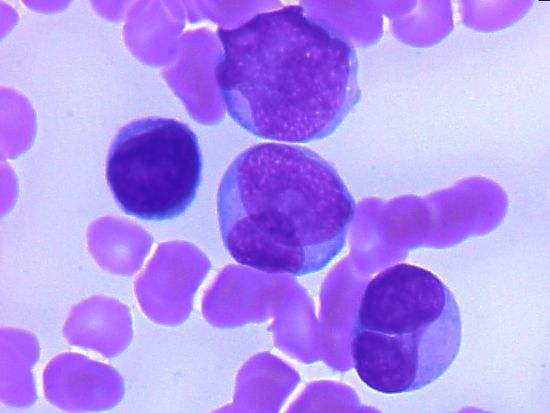 Acute Myeloid Leukaemia