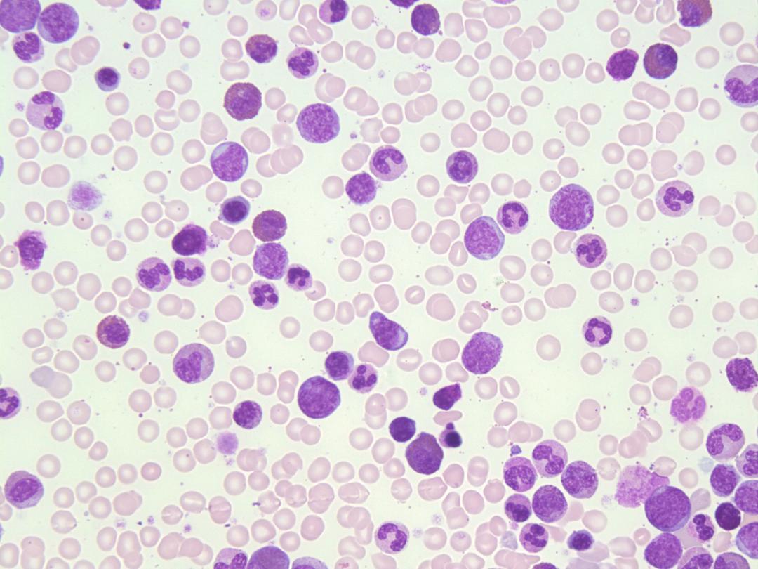 Chronic Myeloid Leukaemia