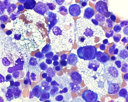 Histiocytic Disorders