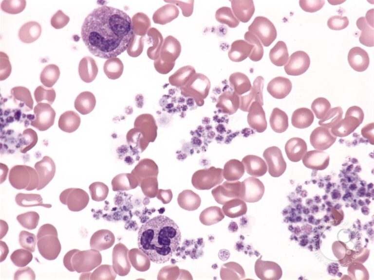 Myeloproliferative Neoplasms