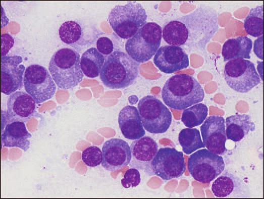 Plasma Cell Dyscrasias